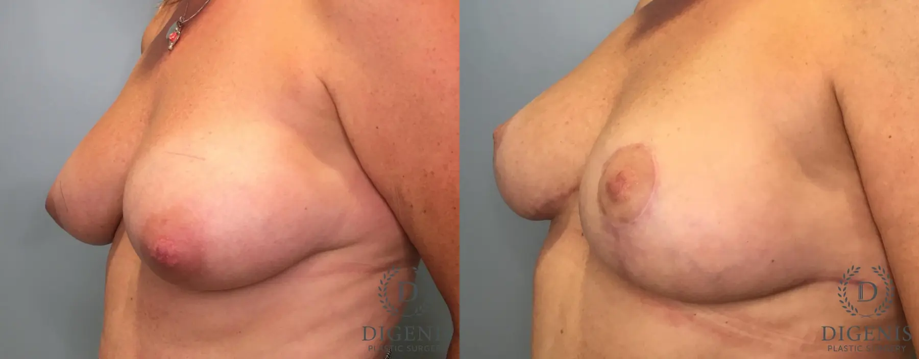 Breast Lift: Patient 42 - Before and After 4