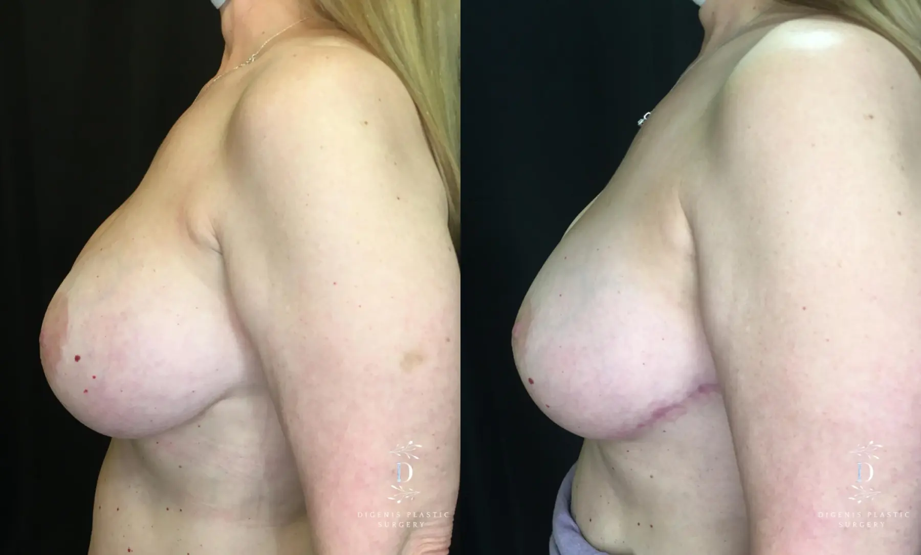 Breast Lift: Patient 23 - Before and After 5