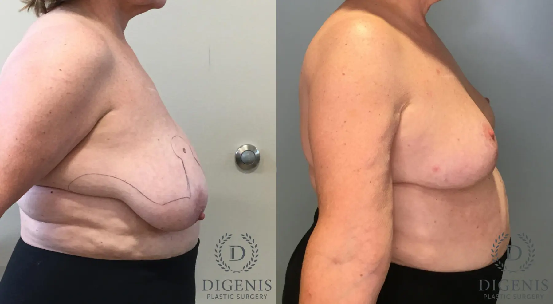 Breast Lift: Patient 36 - Before and After 5