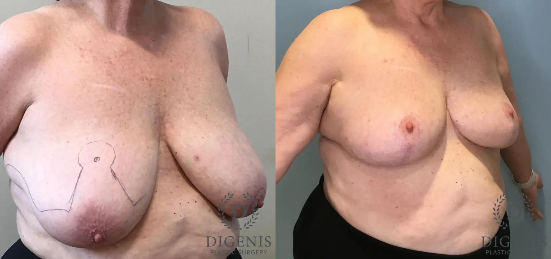 Breast Lift: Patient 36 - Before and After 4