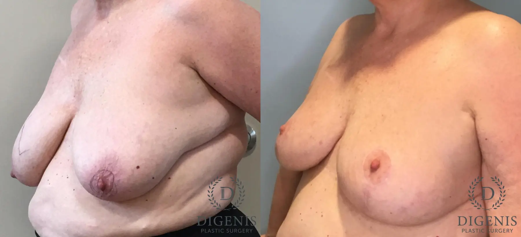 Breast Lift: Patient 36 - Before and After 2