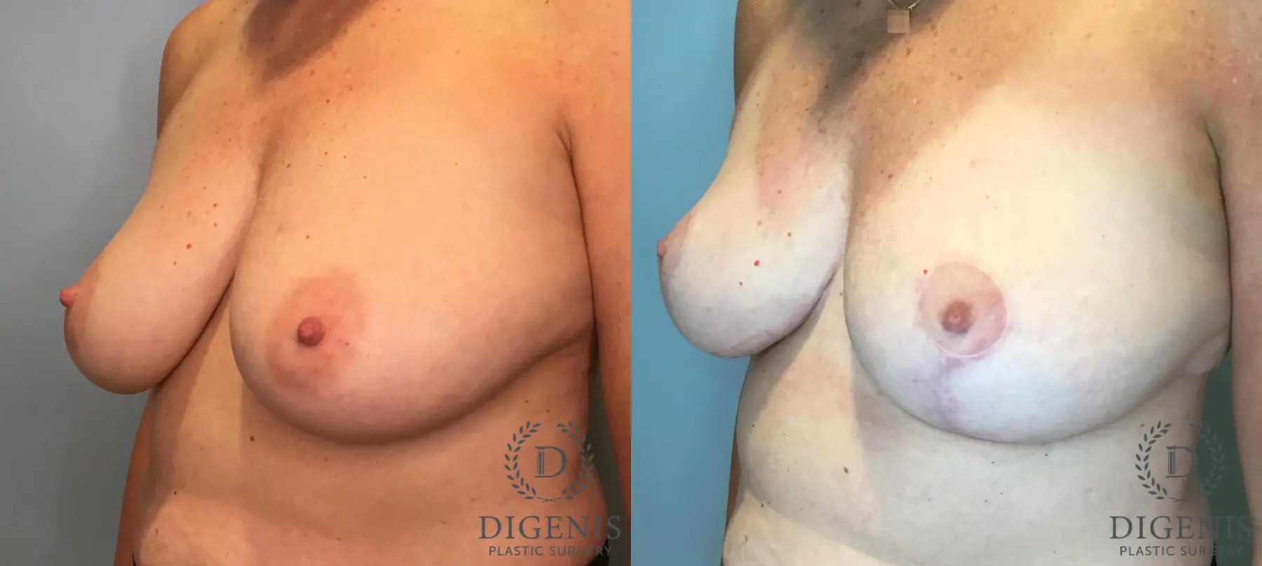 Breast Lift: Patient 46 - Before and After 4