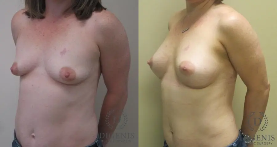 Breast Lift: Patient 7 - Before and After 4