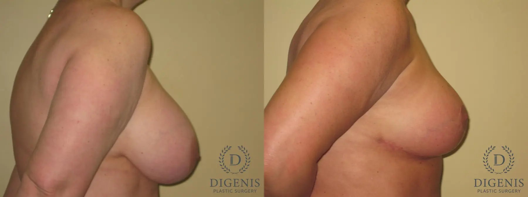 Breast Lift: Patient 18 - Before and After 3