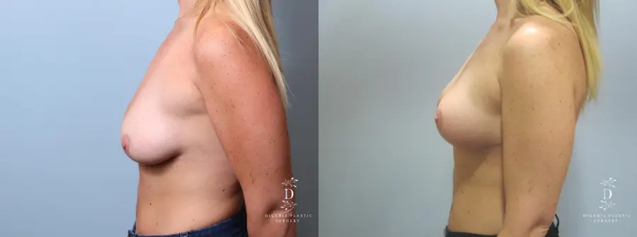 Breast Lift: Patient 7 - Before and After 5