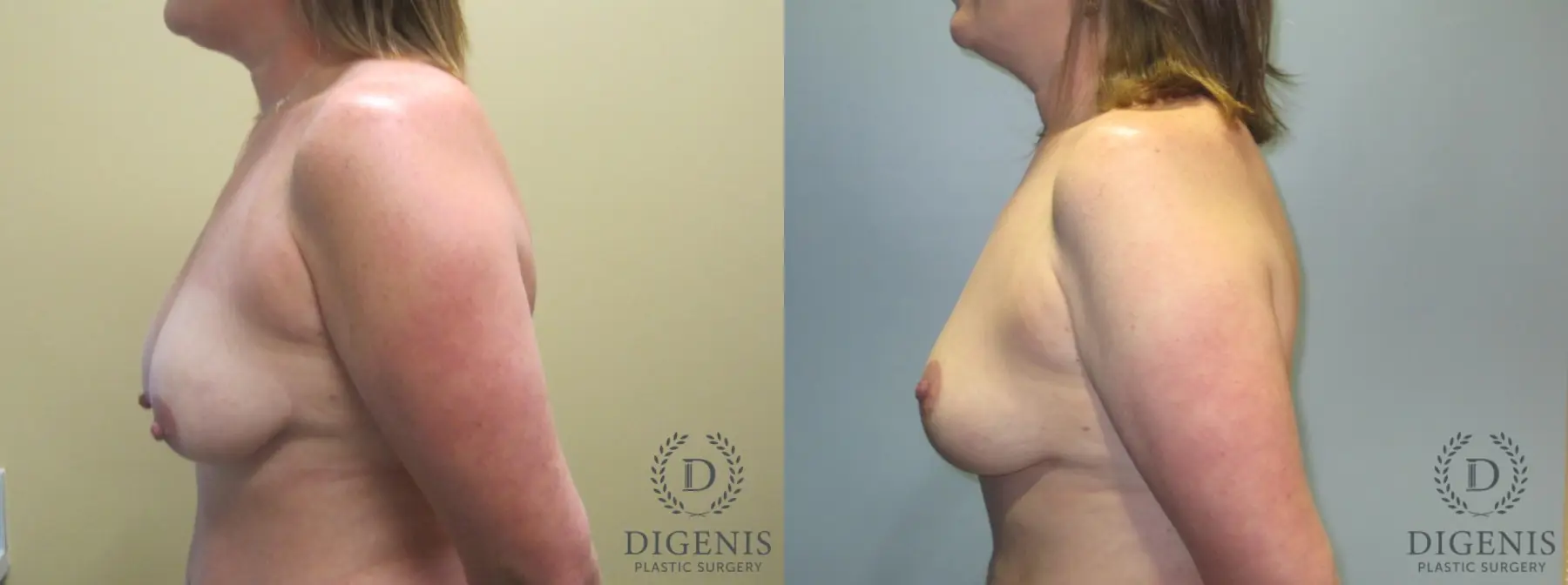 Breast Lift: Patient 5 - Before and After 5