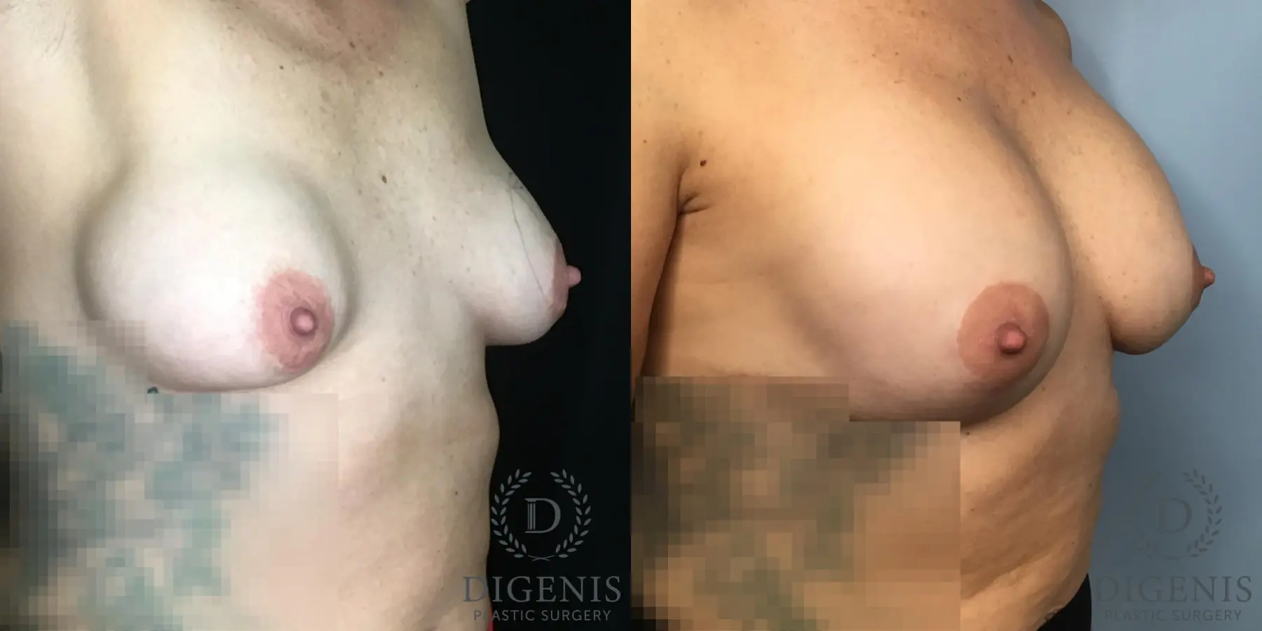 Breast Lift: Patient 37 - Before and After 4