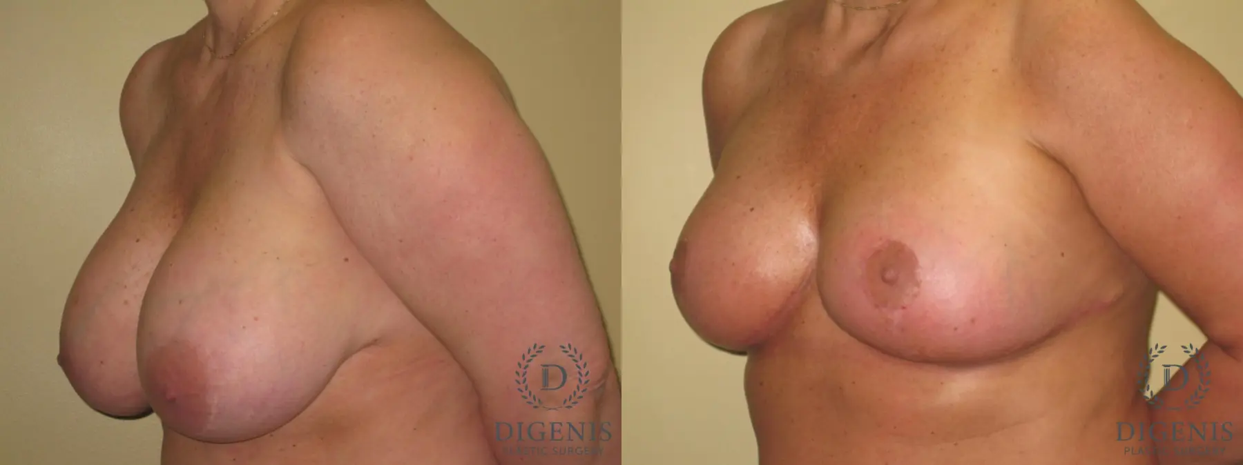 Breast Lift: Patient 18 - Before and After 4
