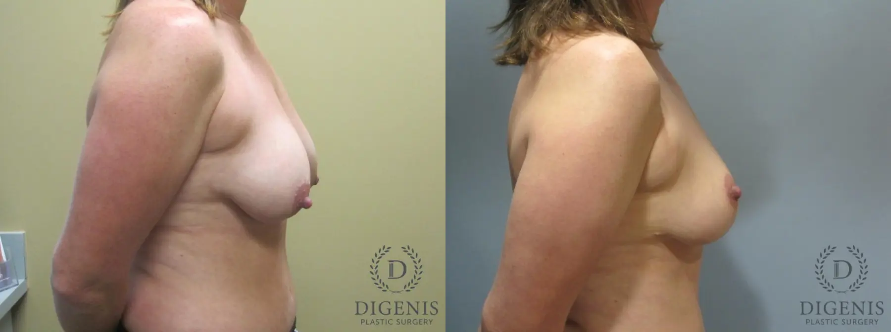 Breast Lift: Patient 5 - Before and After 3