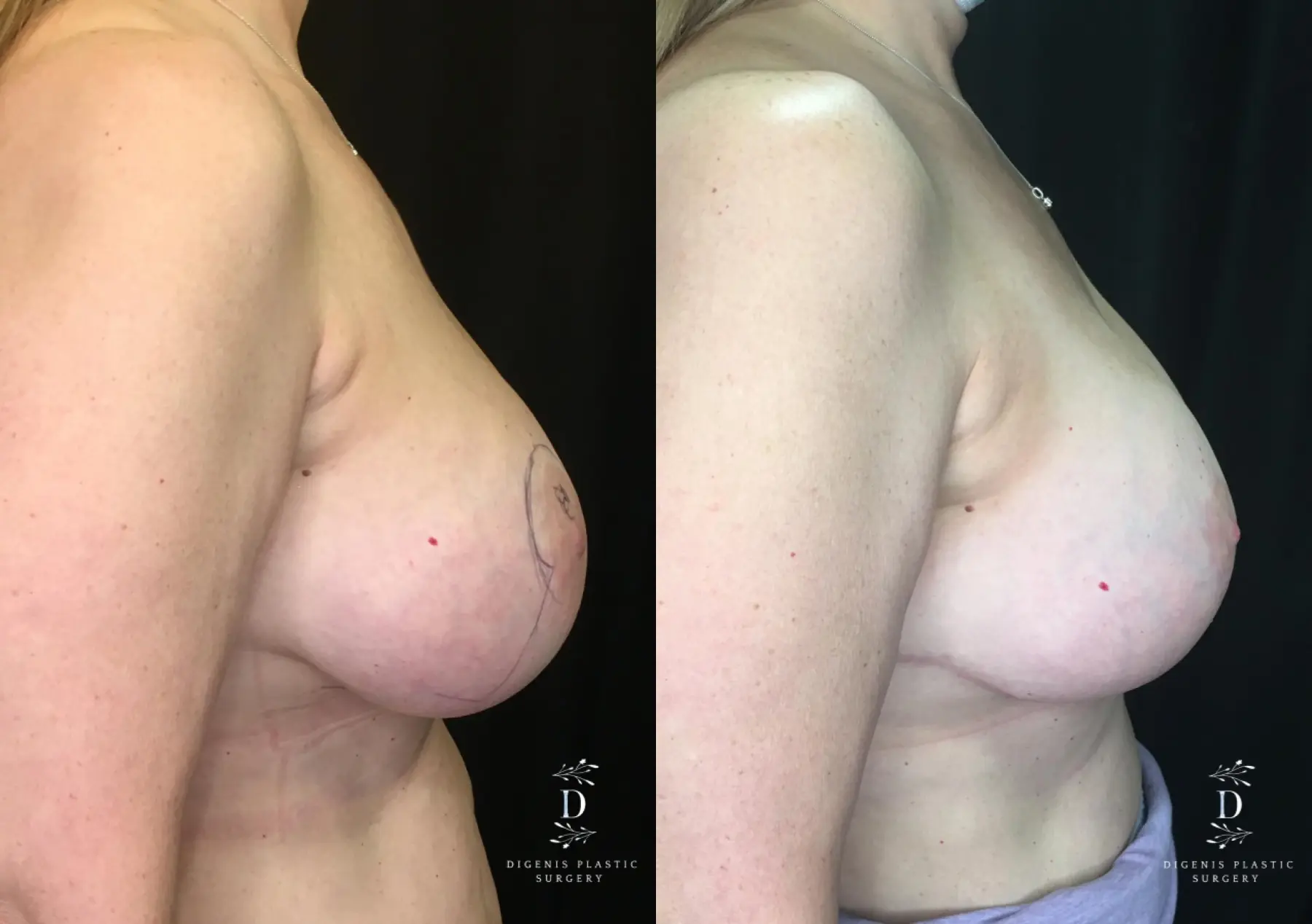 Breast Lift: Patient 23 - Before and After 3