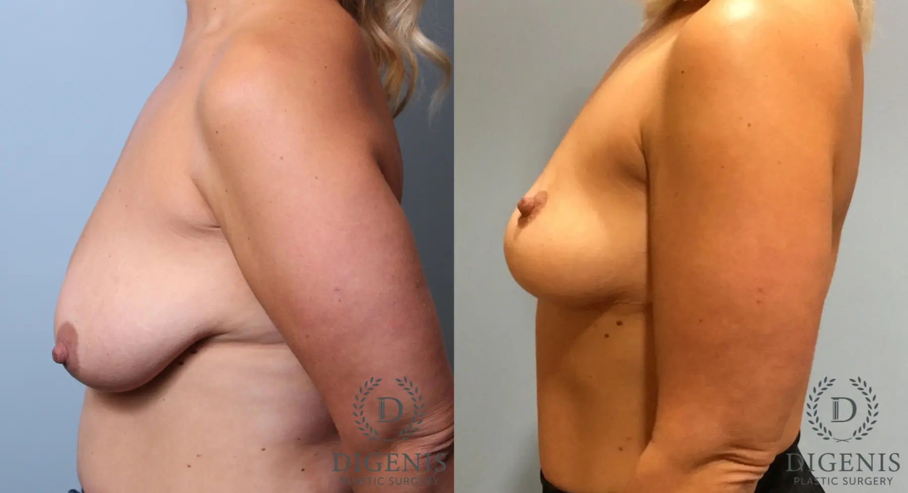 Breast Lift: Patient 4 - Before and After 5