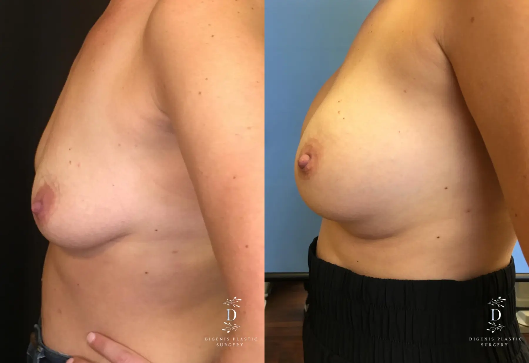 Breast Lift: Patient 25 - Before and After 5
