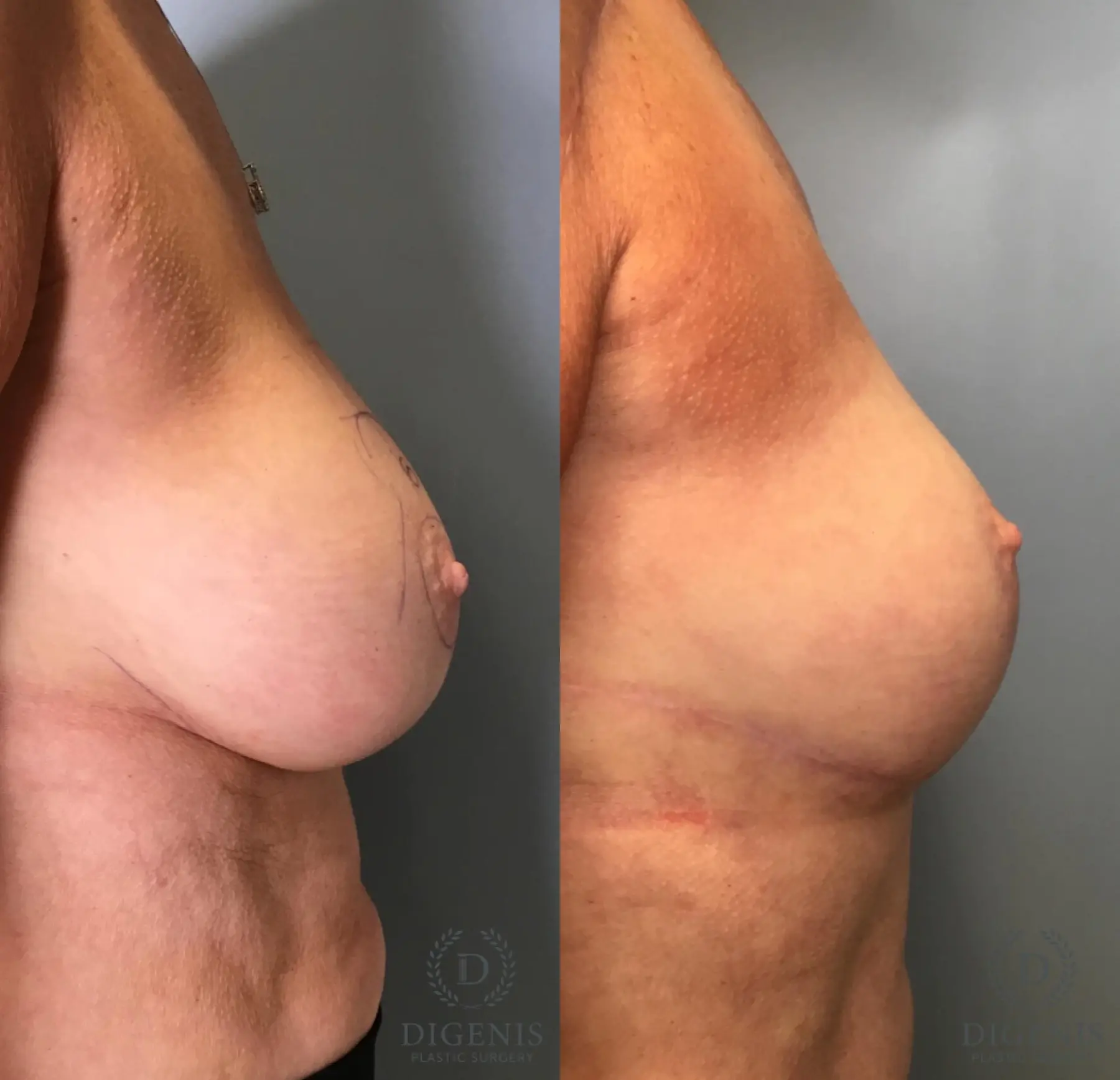 Breast Lift: Patient 4 - Before and After 5