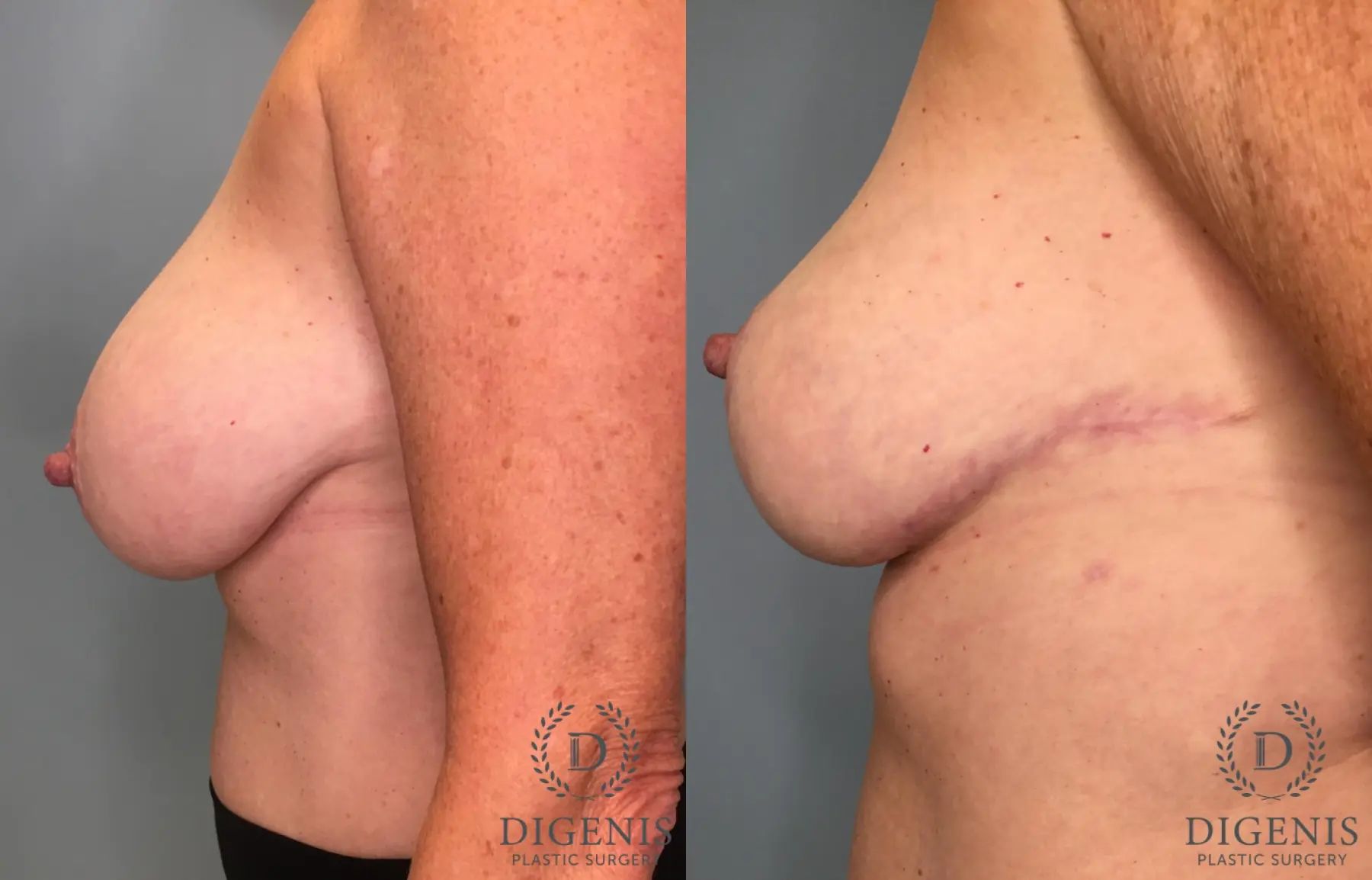 Breast Lift: Patient 39 - Before and After 5
