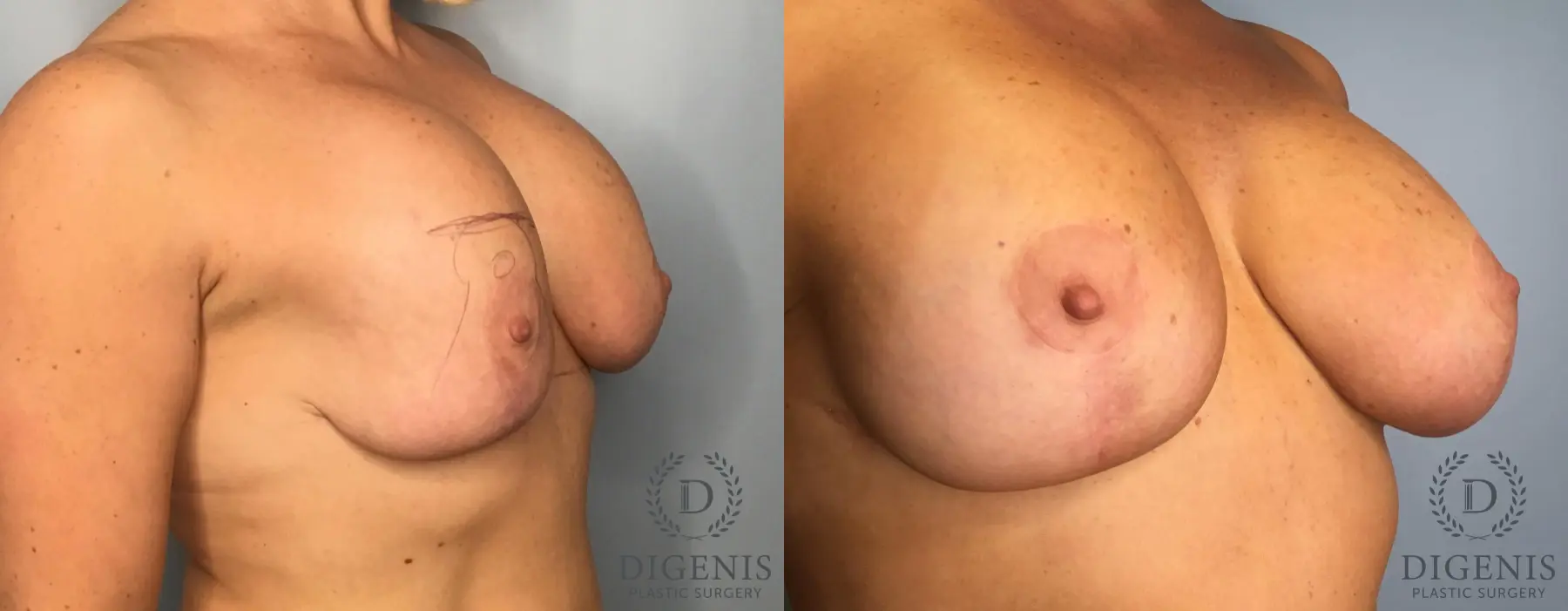 Breast Lift: Patient 43 - Before and After 2