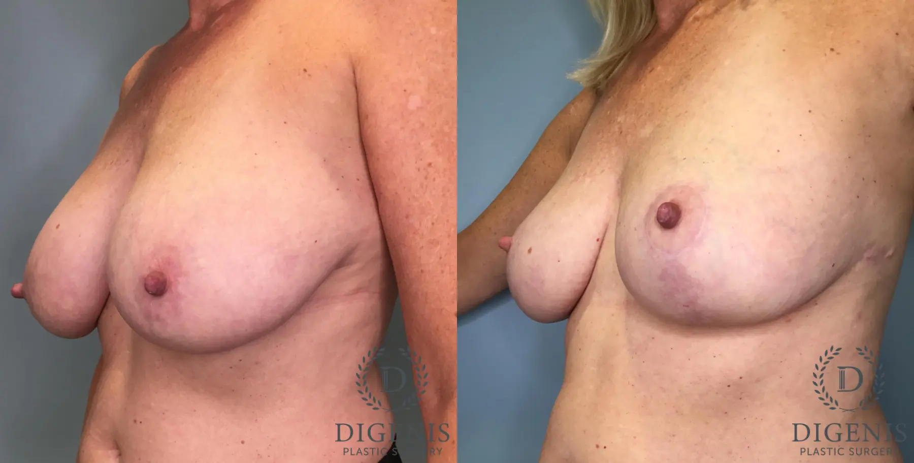 Breast Lift: Patient 39 - Before and After 4