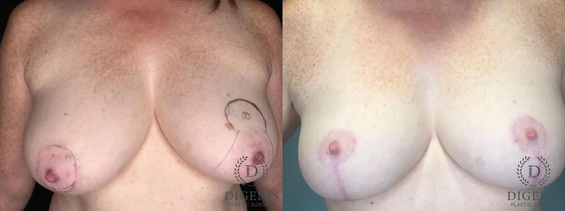 Breast Lift: Patient 35 - Before and After 1