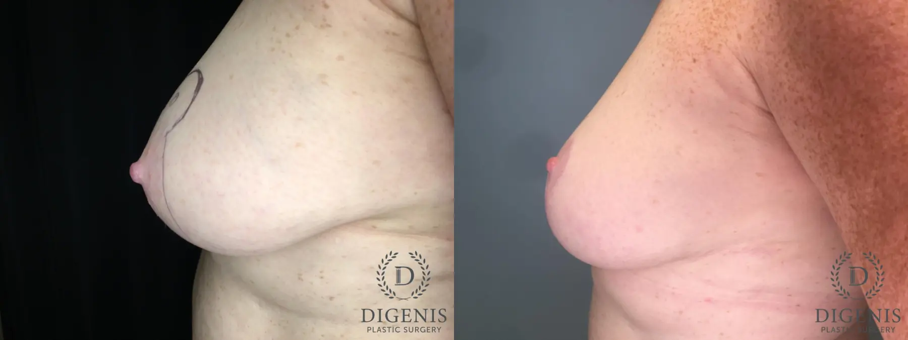 Breast Lift: Patient 35 - Before and After 3