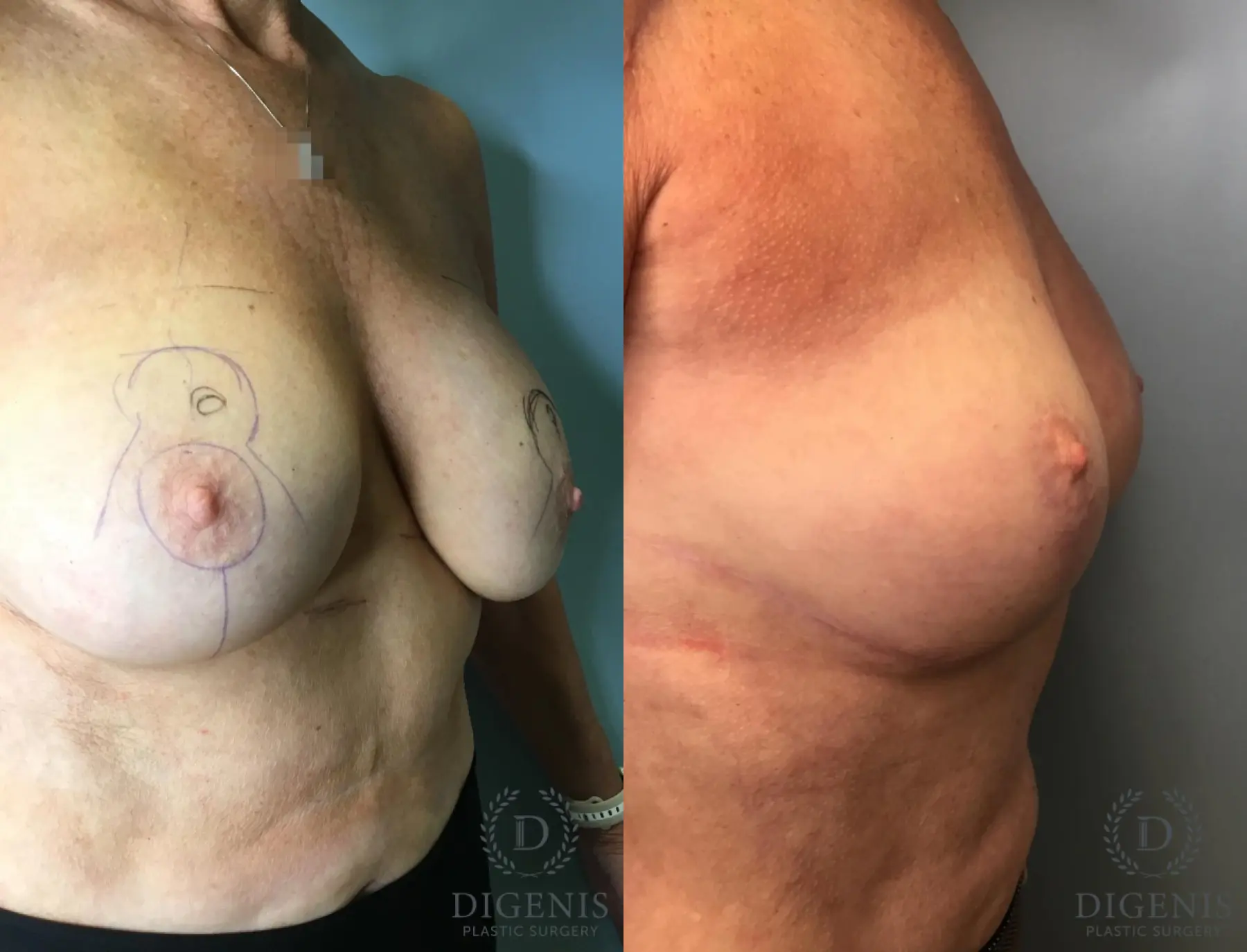 Breast Lift: Patient 4 - Before and After 4