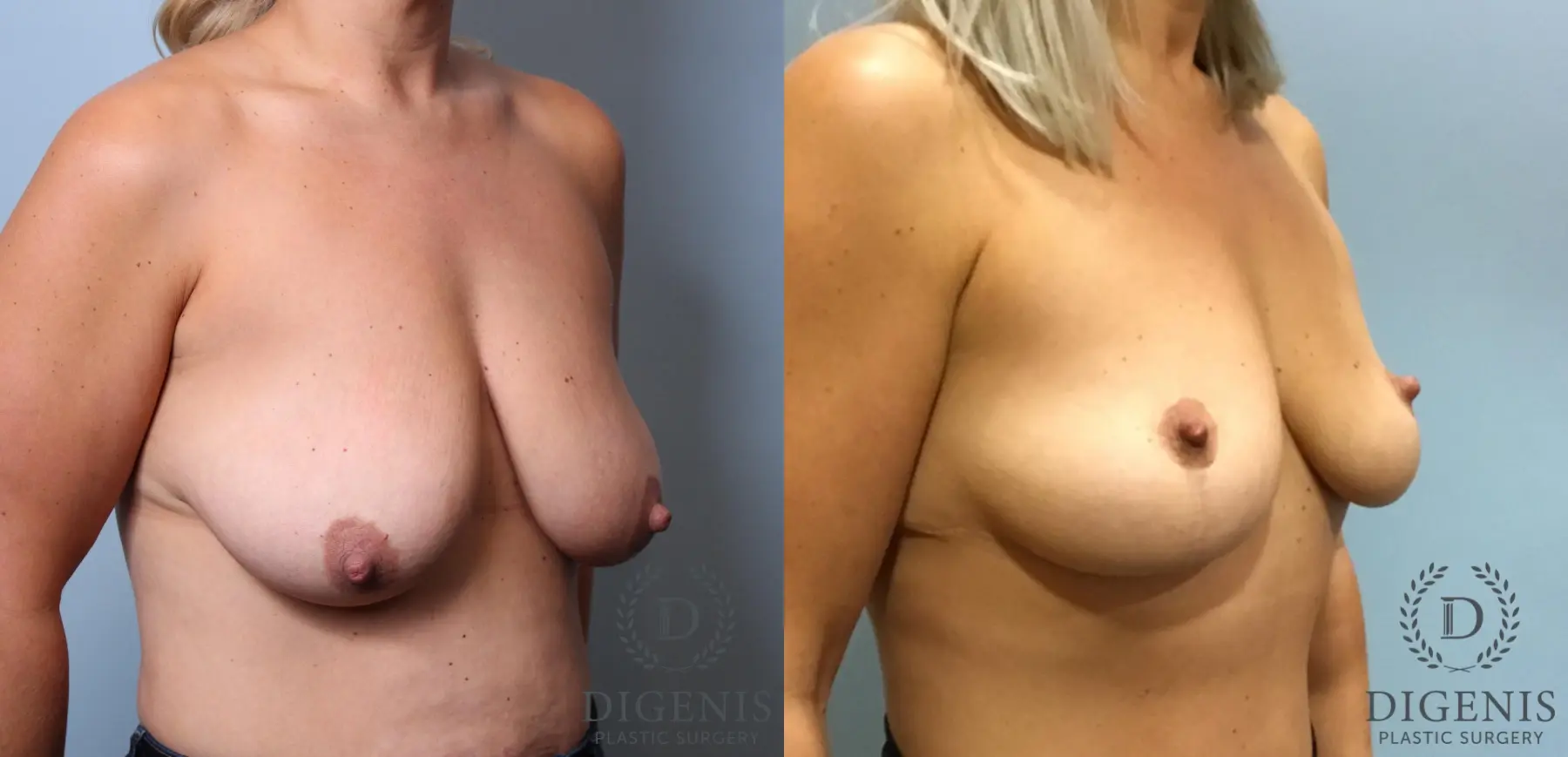 Breast Lift: Patient 4 - Before and After 2