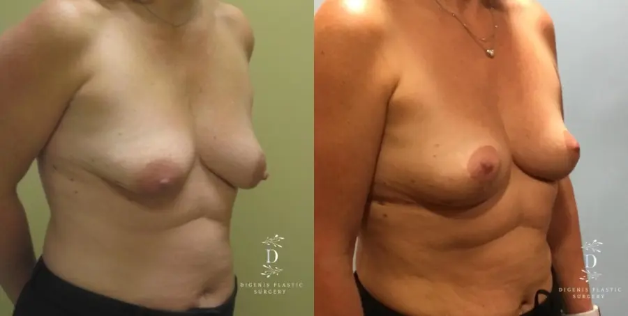 Breast Lift: Patient 9 - Before and After 3