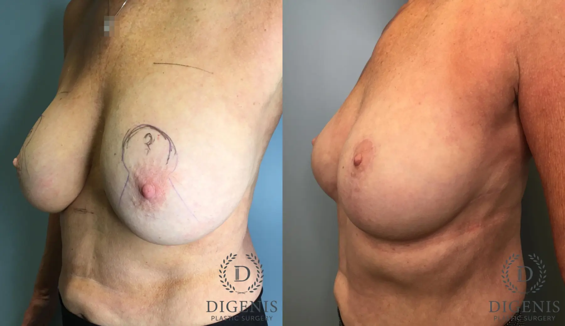 Breast Lift: Patient 4 - Before and After 2