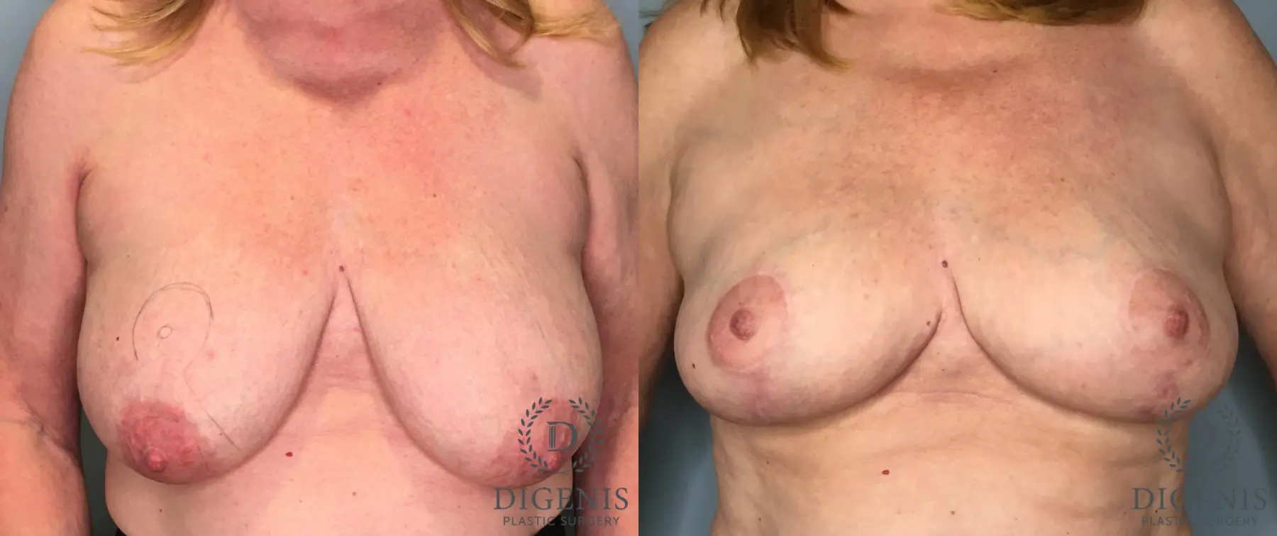 Breast Lift: Patient 6 - Before and After  
