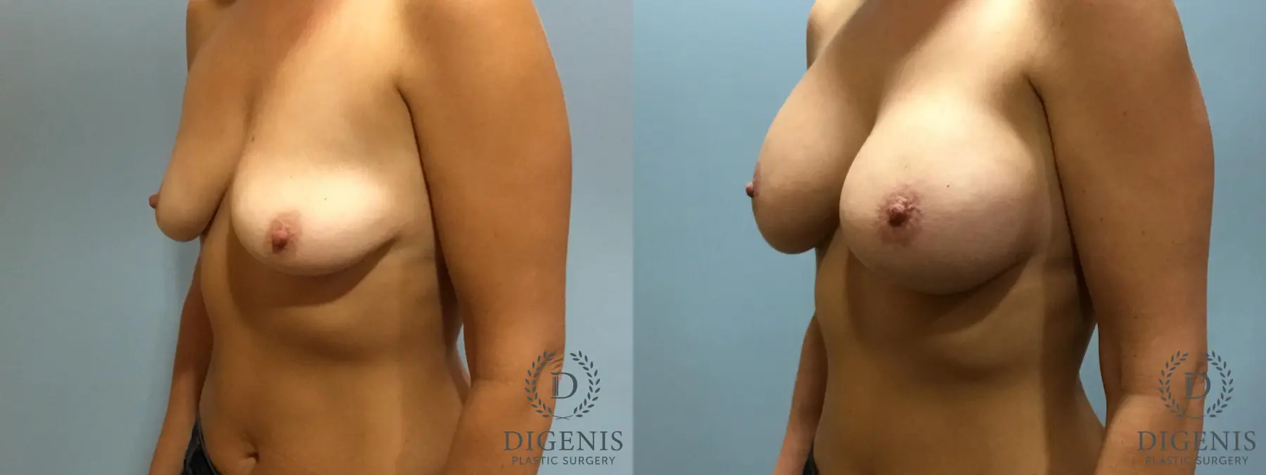 Breast Lift: Patient 13 - Before and After 4