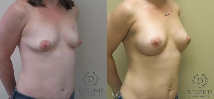 Breast Lift: Patient 7 - Before and After 2