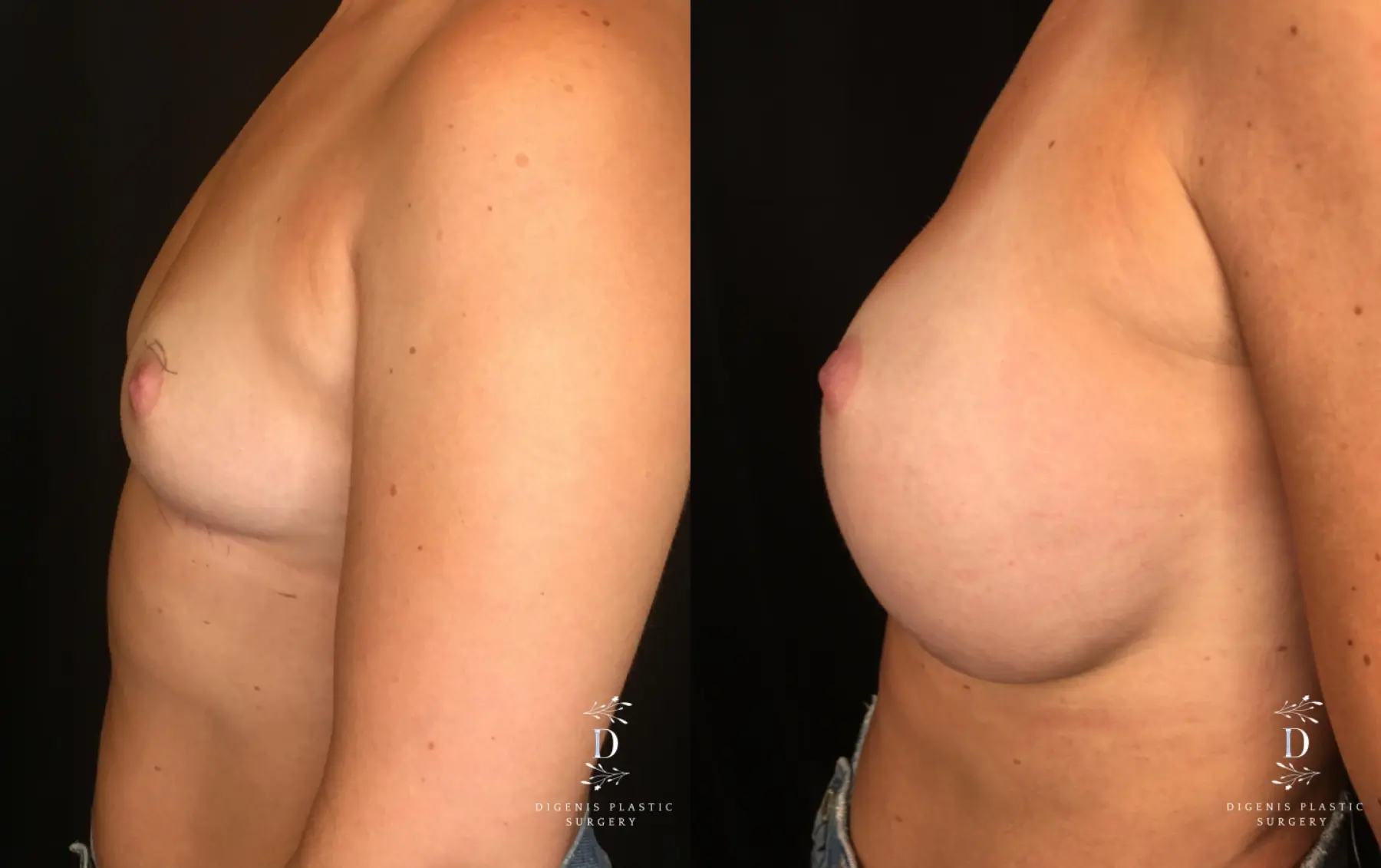Breast Lift: Patient 24 - Before and After 5
