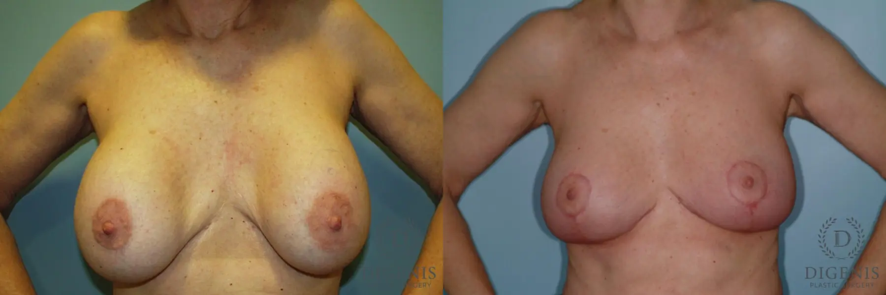 Breast Lift: Patient 16 - Before and After  