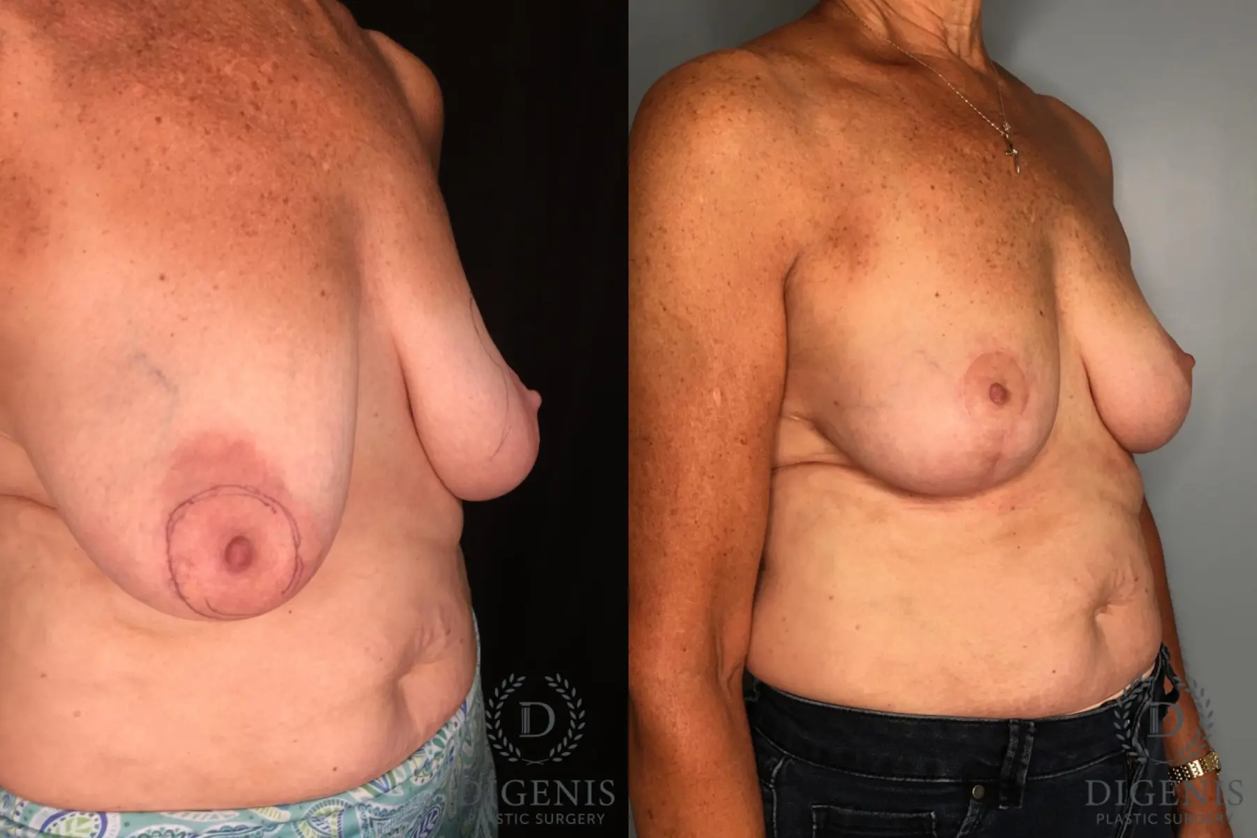 Breast Lift: Patient 31 - Before and After 2