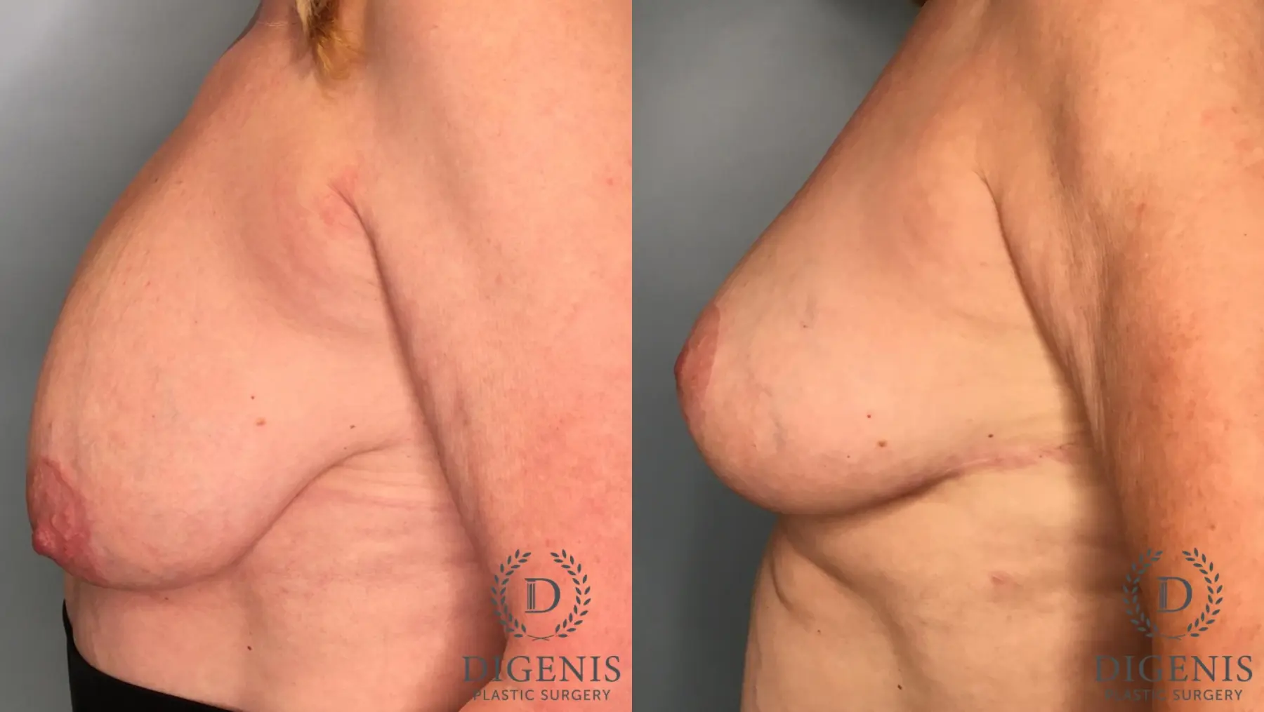 Breast Lift: Patient 6 - Before and After 3