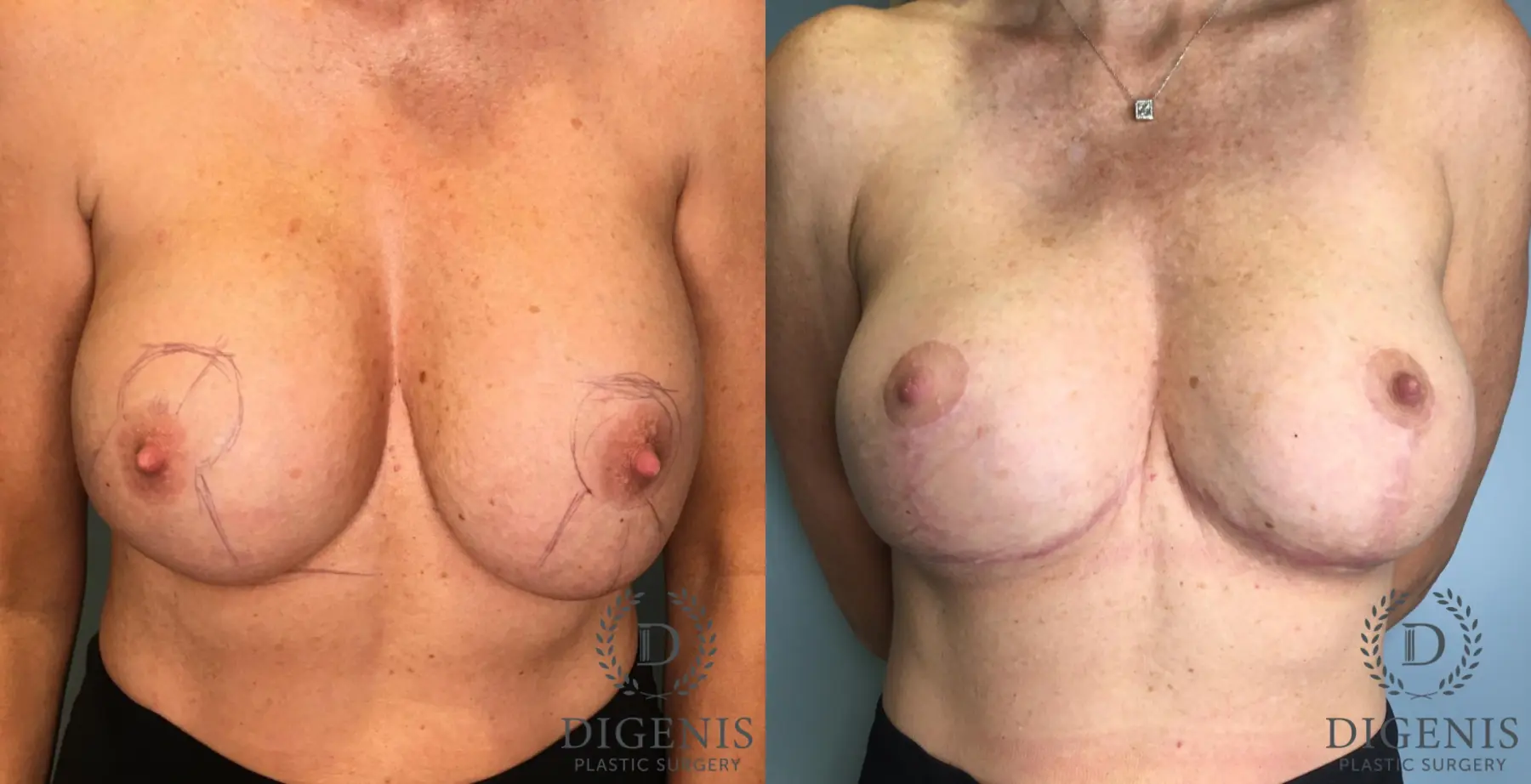 Breast Lift: Patient 41 - Before and After  