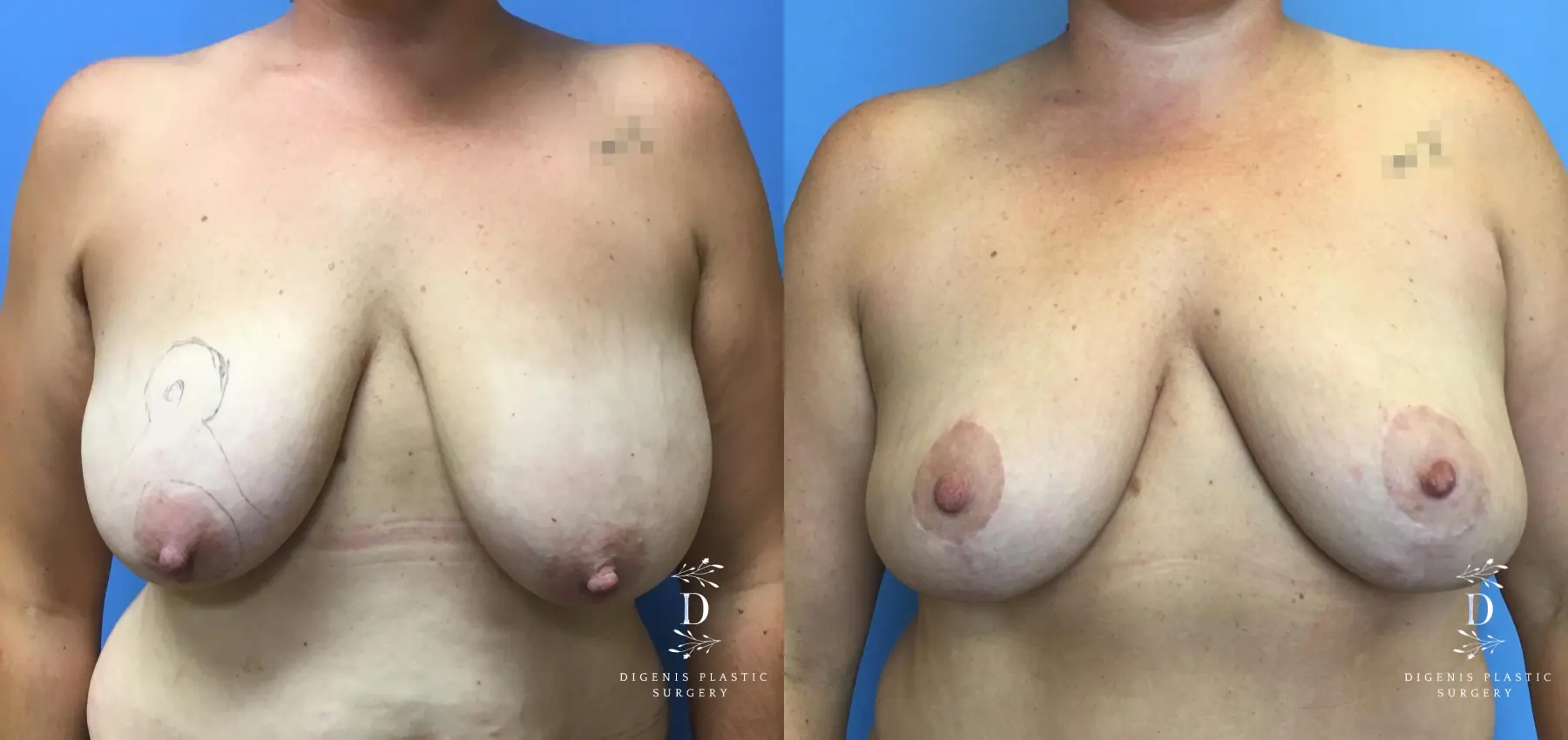 Breast Lift: Patient 8 - Before and After  