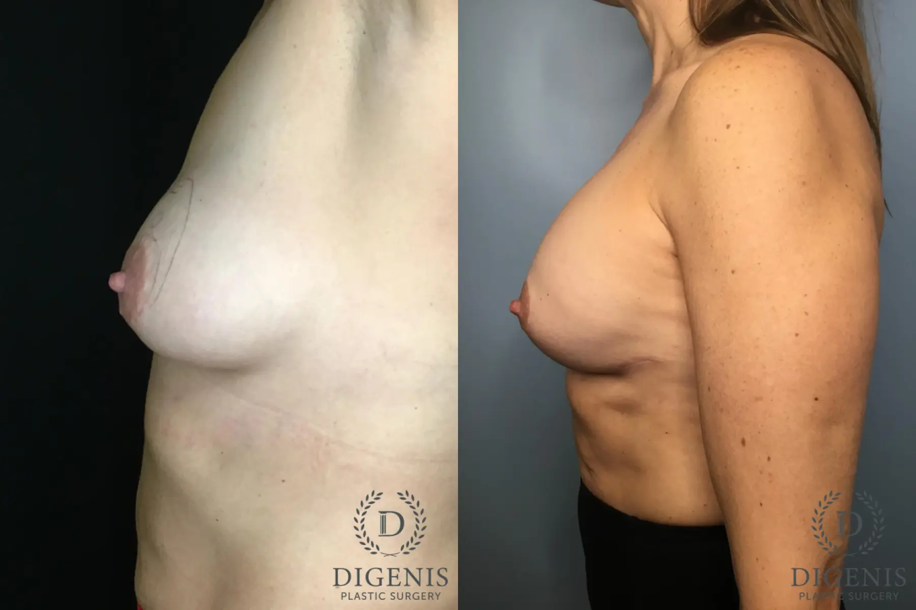 Breast Lift: Patient 37 - Before and After 3