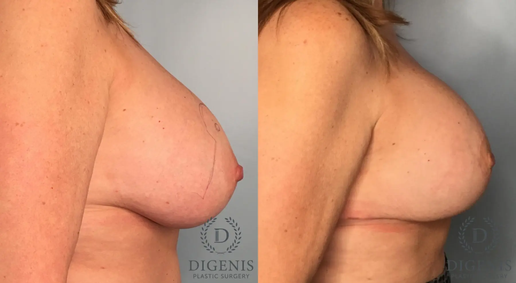 Breast Lift: Patient 38 - Before and After 2