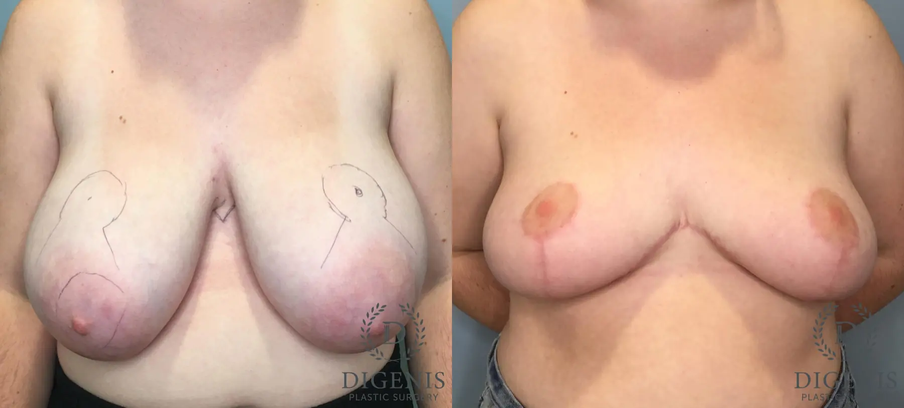 Breast Lift: Patient 1 - Before and After  