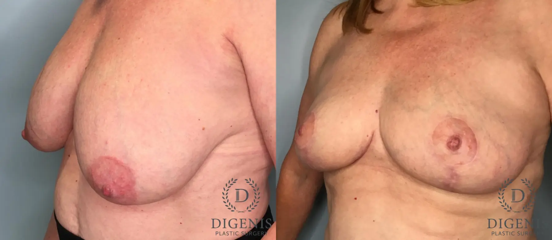 Breast Lift: Patient 6 - Before and After 2