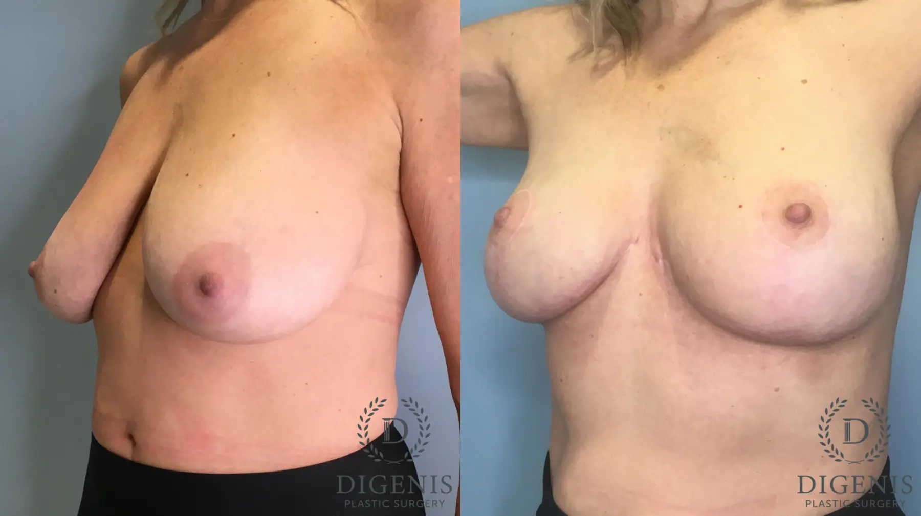 Breast Lift: Patient 5 - Before and After 3