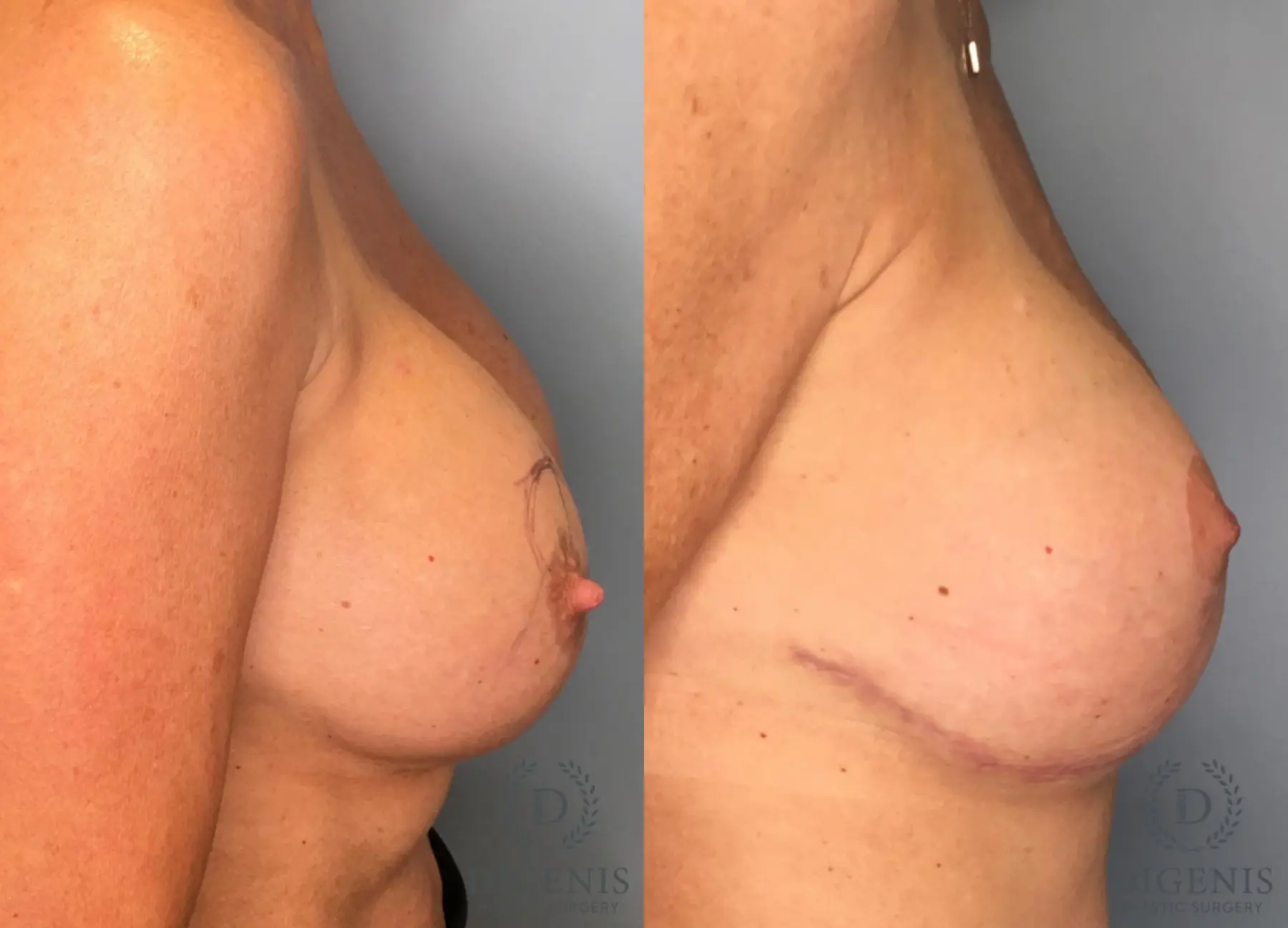 Breast Lift: Patient 41 - Before and After 2