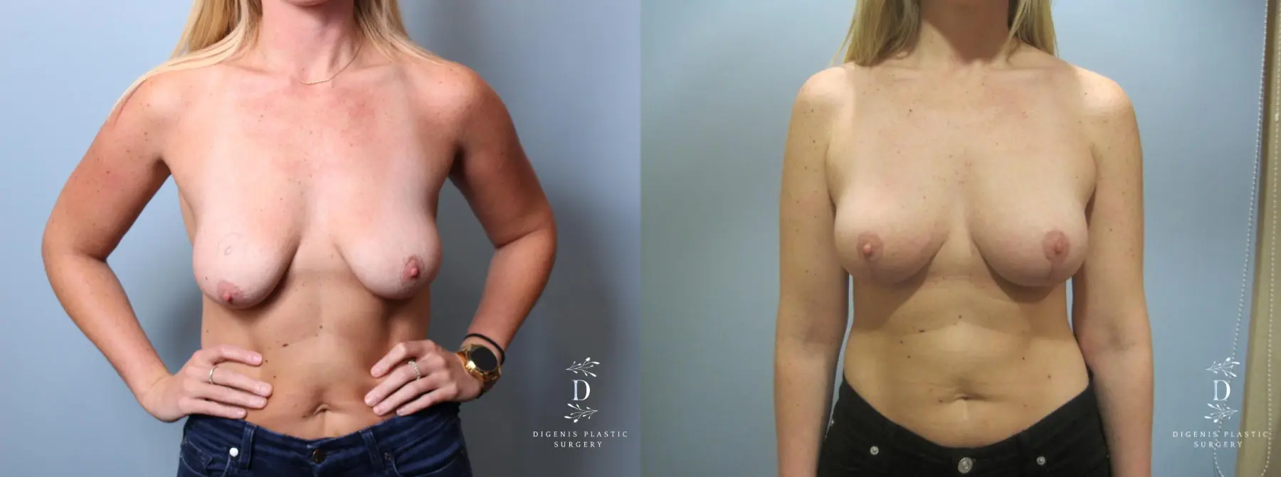 Breast Lift: Patient 7 - Before and After 1
