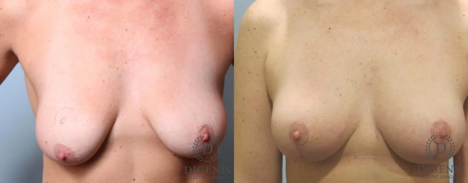 Breast Lift: Patient 7 - Before and After  