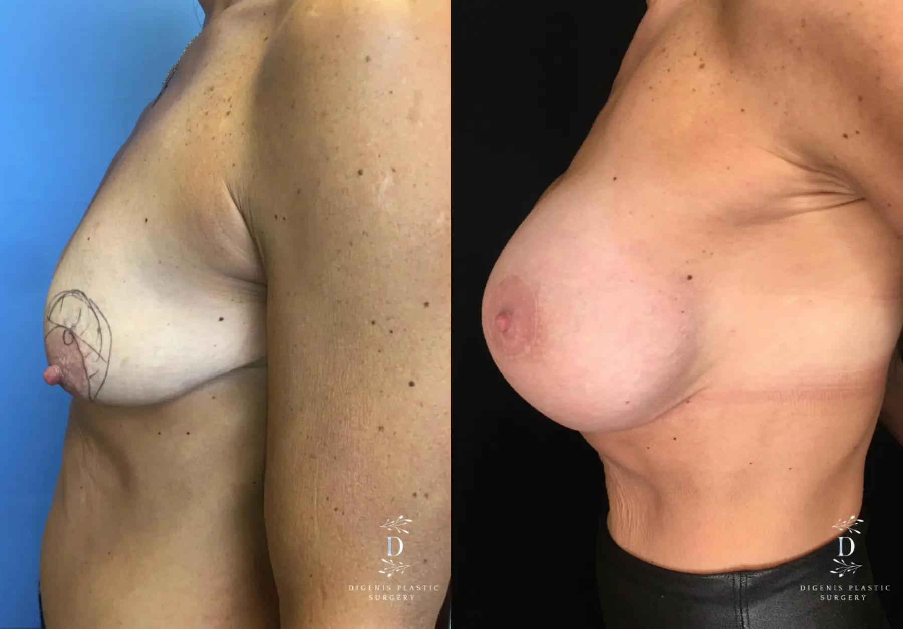 Breast Lift: Patient 28 - Before and After 5