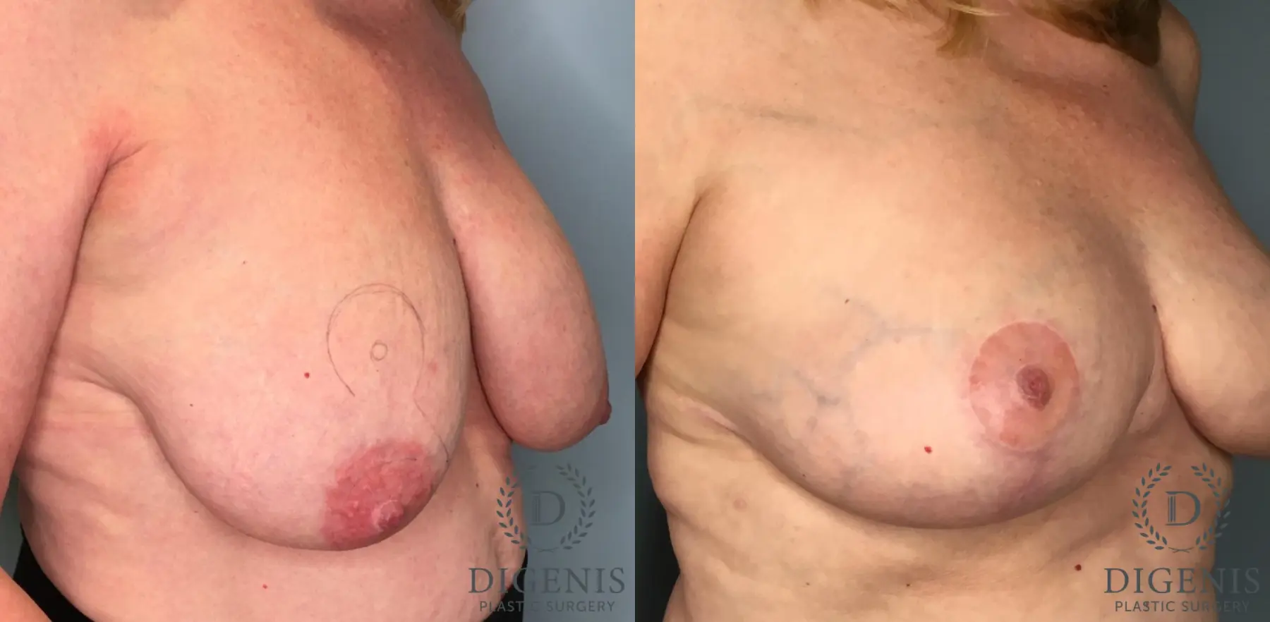 Breast Lift: Patient 6 - Before and After 4