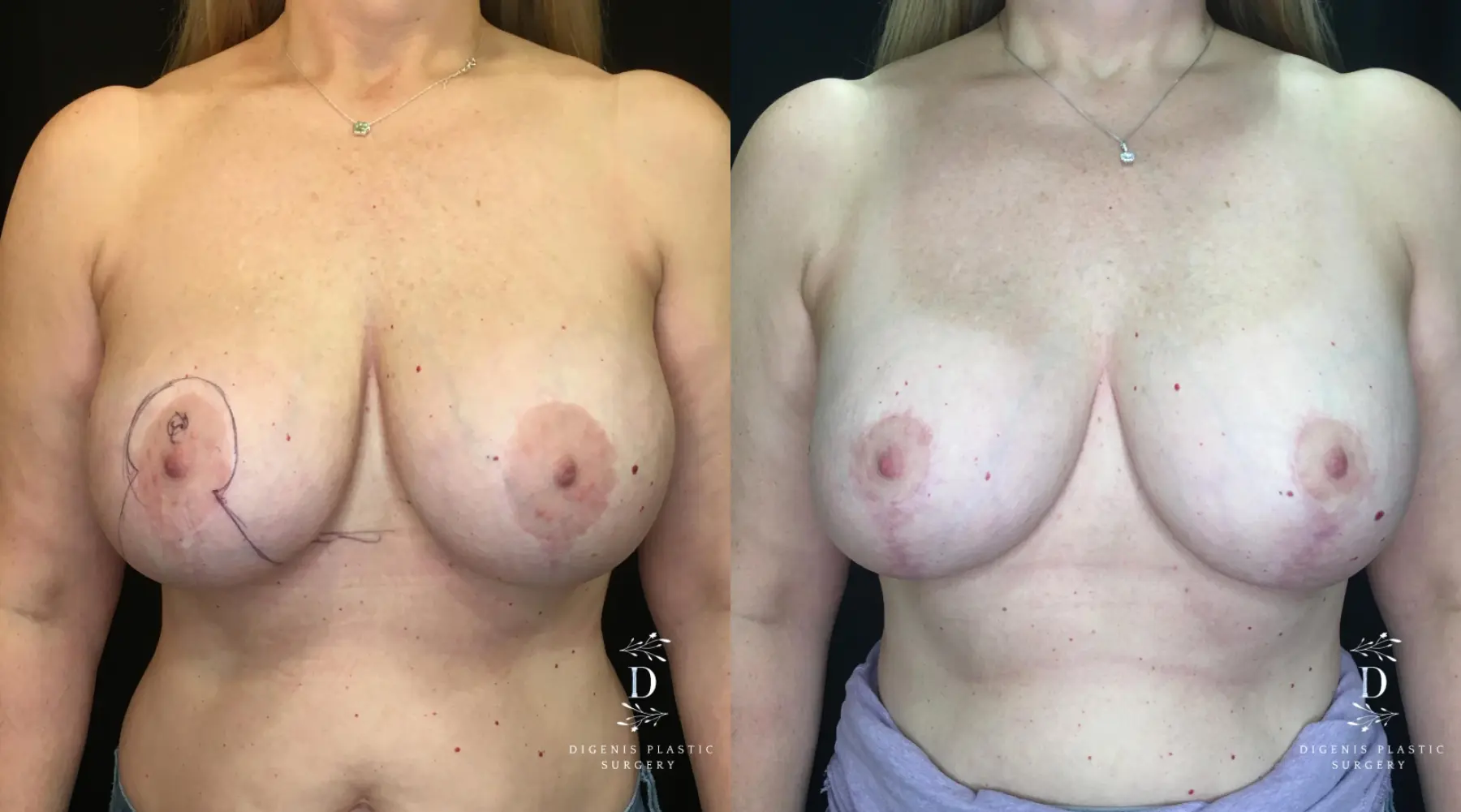 Breast Lift: Patient 23 - Before and After  