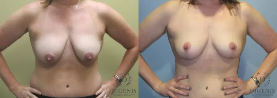 Breast Lift: Patient 5 - Before and After  
