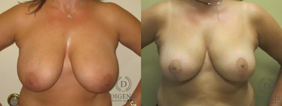 Breast Lift: Patient 1 - Before and After  