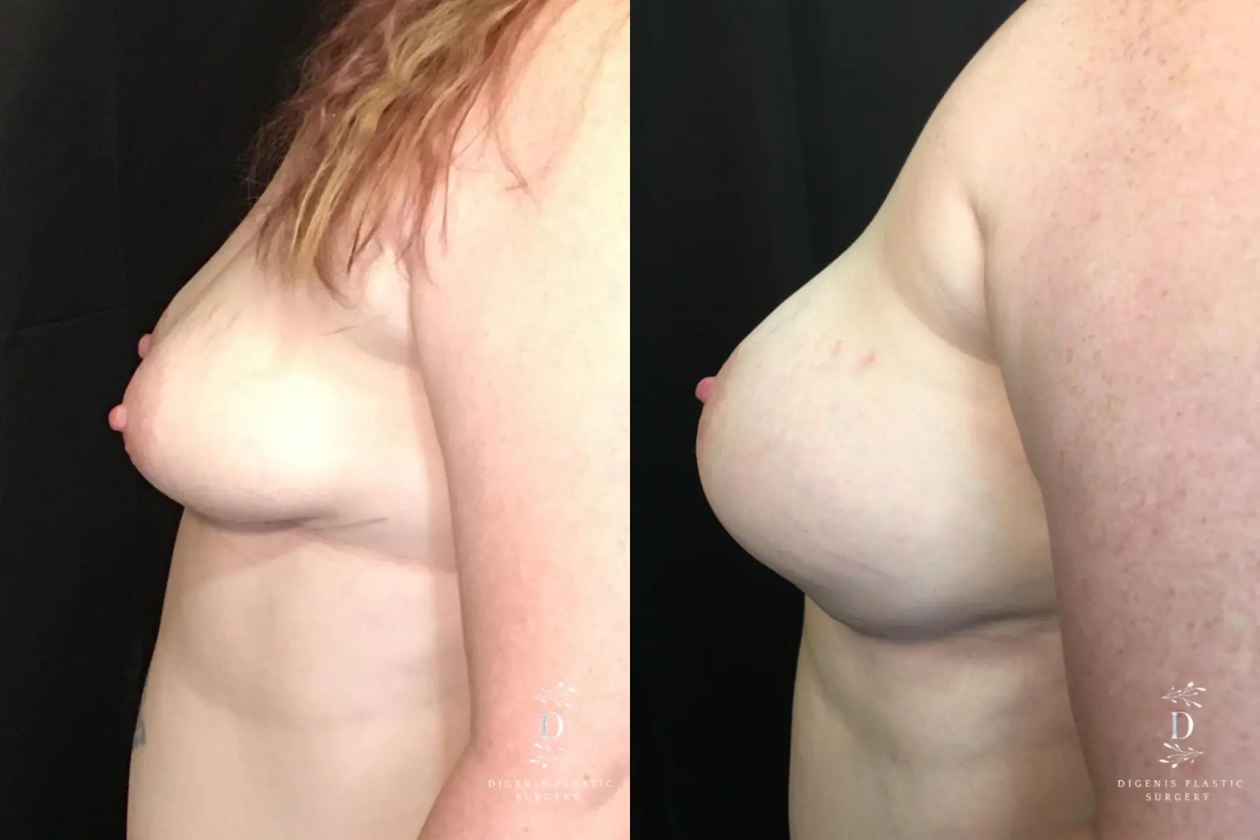Breast Lift: Patient 27 - Before and After 5