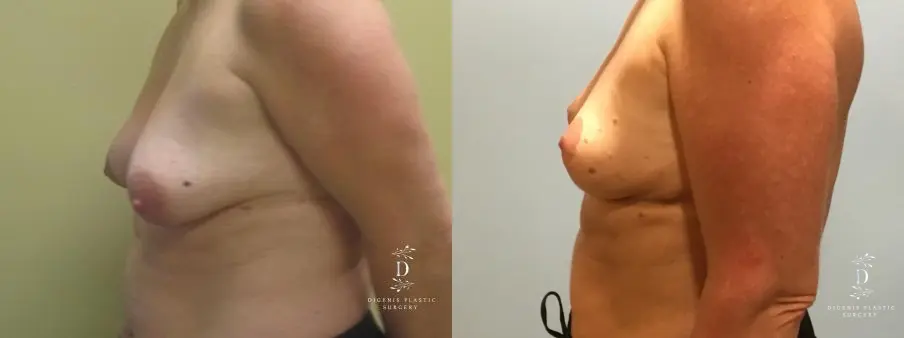 Breast Lift: Patient 9 - Before and After 5
